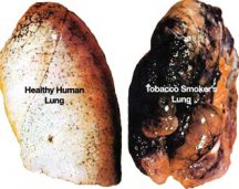 Healthy Lung and smoker lung